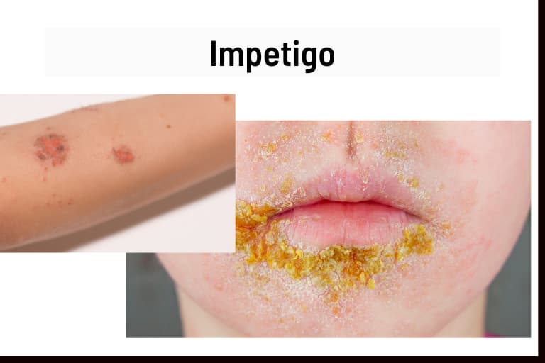 What Is Impetigo Red Impetigo Causes Symptoms And Treatment ECGZCE What Is Impetigo Red Impetigo Causes Symptoms And Treatment ECGZCE