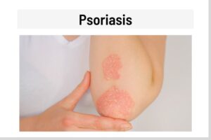 10 Causes of a Circular Rash, with Pictures