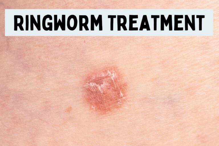Cks Ringworm In Adults What Does Ringworm Do FZPY