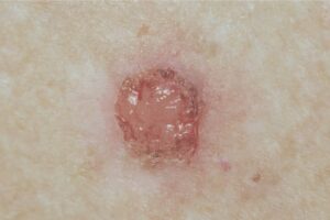 Scabs and Sores on Scalp: 17 Causes, Pictures and Treatment
