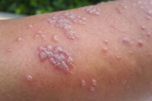 Rash Features Rash: 36 Common Skin Rashes, Pictures, Causes & Treatment