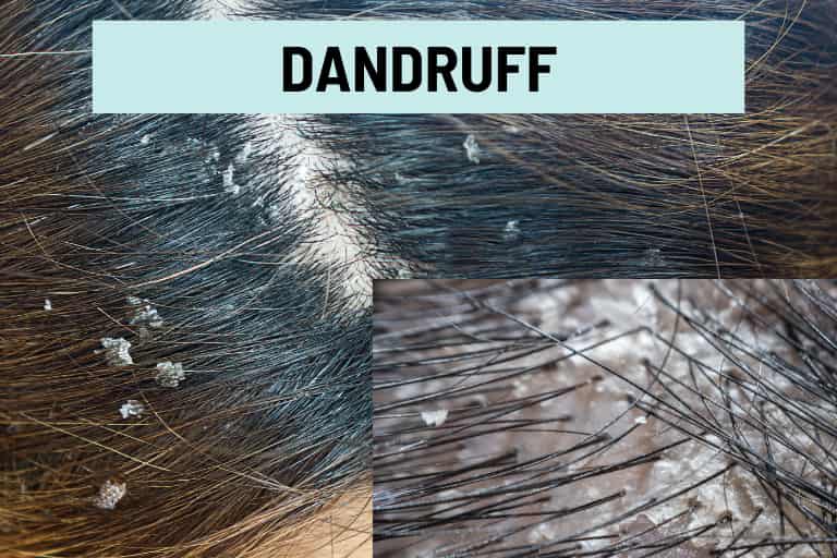 Dandruff Flakes