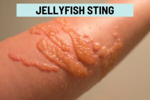 Bubble Rash Skin Itchy Bumps Filled With Clear Liquid: 16 Itchy Blister Rashes