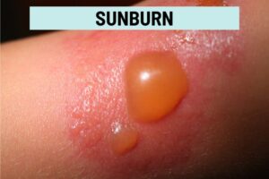 Itchy Bumps Filled With Clear Liquid: 16 Itchy Blister Rashes