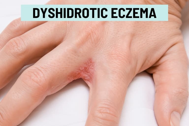 Dyshidrotic Eczema What Causes These Summer Finger Bumps Dyshidrotic Eczema What Causes These Summer Finger Bumps