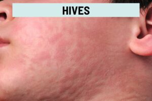 Redness on Face: 23 Causes and How to Reduce It