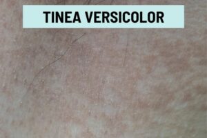 Tinea Versicolor: Healing Stages, Pictures, and Treatment