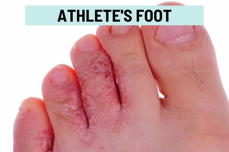 Athlete s Foot Between Toes Won t Go Away At Forrest Sliger Blog Athlete s Foot Between Toes Won t Go Away At Forrest Sliger Blog