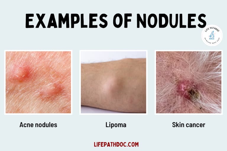 Papule Vs Pustule Vs Nodule Pictures Differences And Causes