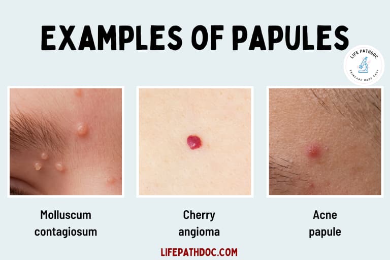 Papule Versus Nodule 20 Types Of Skin Lesions Causes And Pictures 