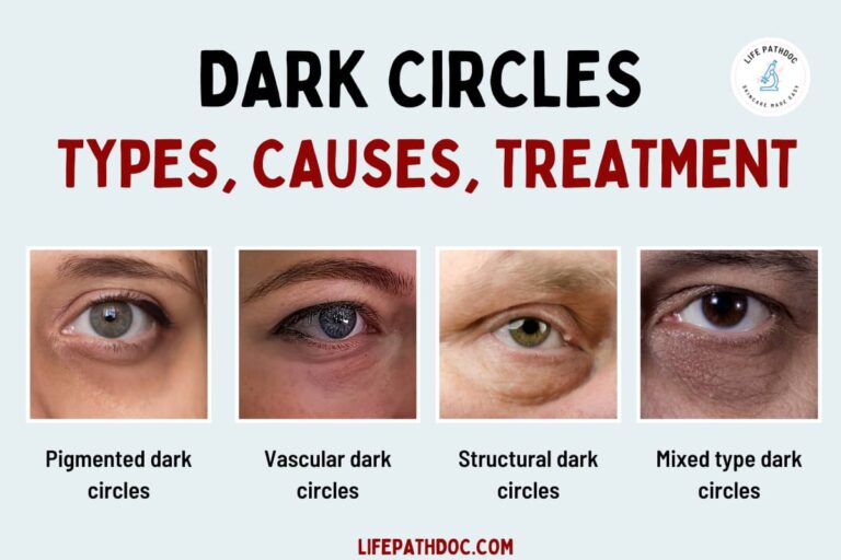 Dark Circles Under The Eyes Causes Types Treatments