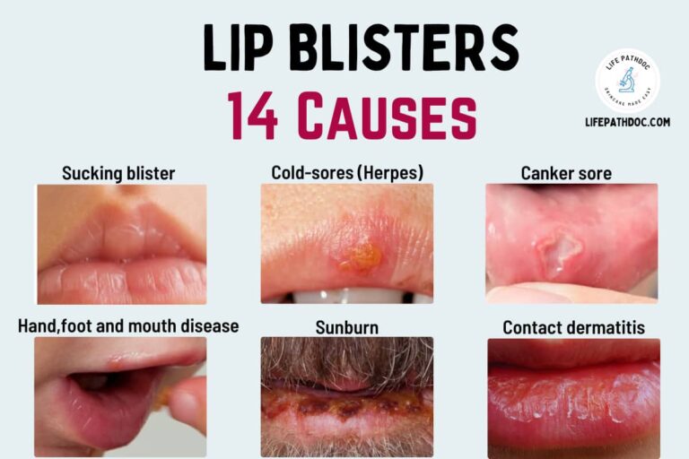 Blister On Lip Cold Sores And 13 Other Causes with Pictures Blister On Lip Cold Sores And 13 Other Causes with Pictures