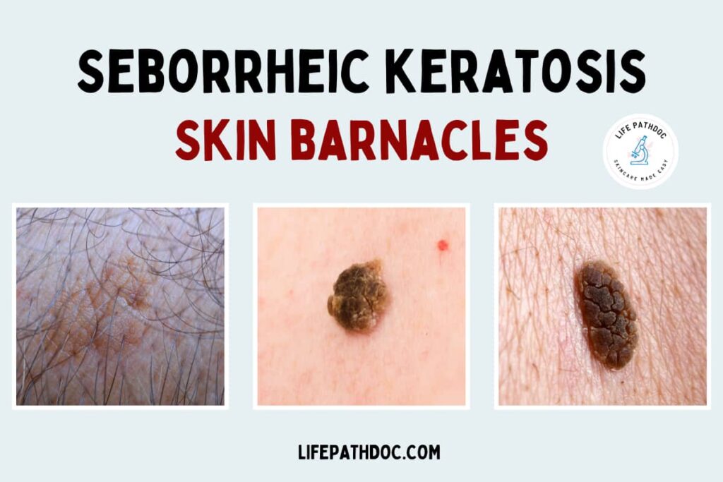 What Causes Skin Barnacles At Charlott Leff Blog What Causes Skin Barnacles At Charlott Leff Blog