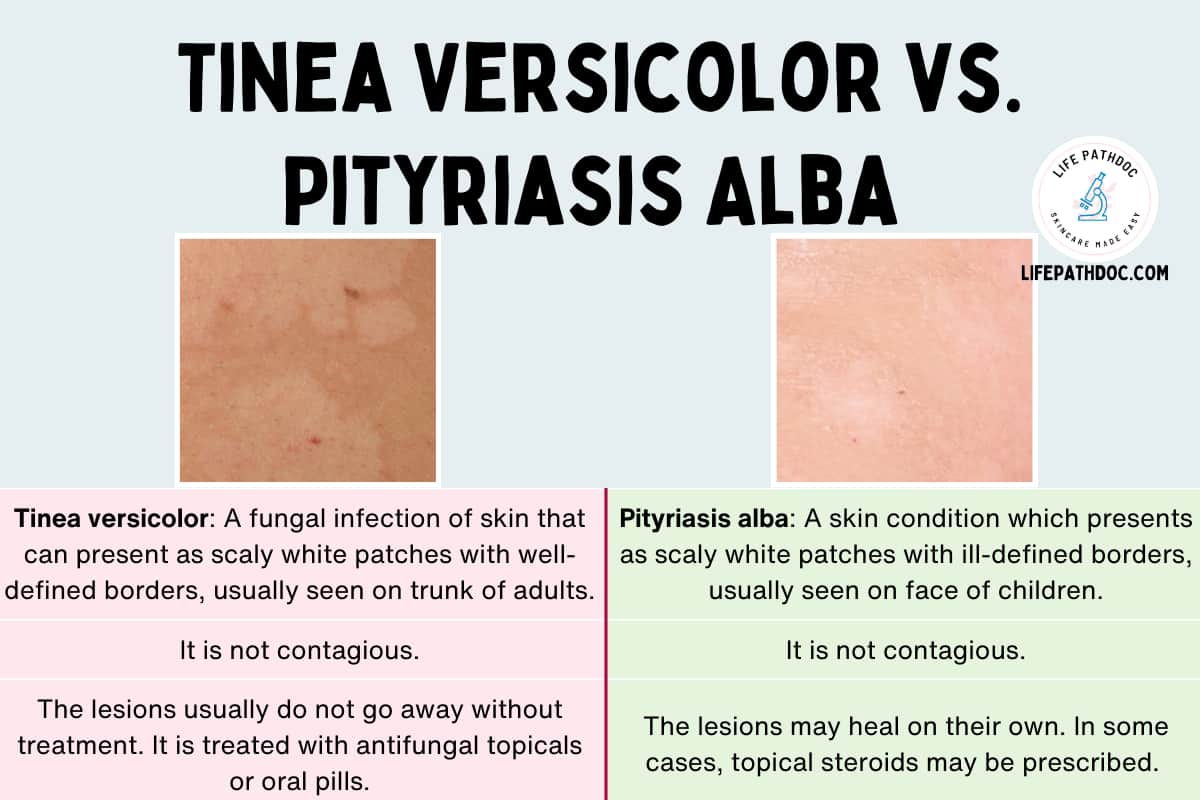 Pityriasis Versicolor Vs Vitiligo GXRAJM