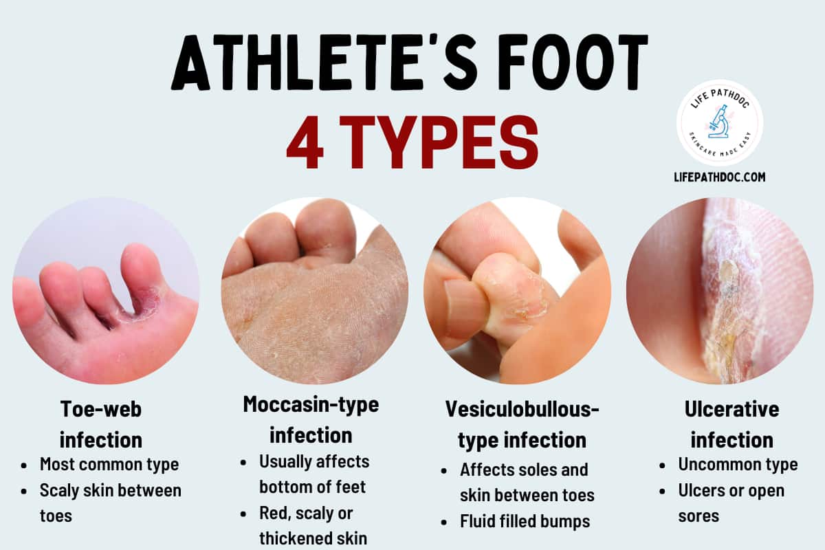 What Does Athlete Foot Mean At Lincoln Parkes Blog What Does Athlete Foot Mean At Lincoln Parkes Blog