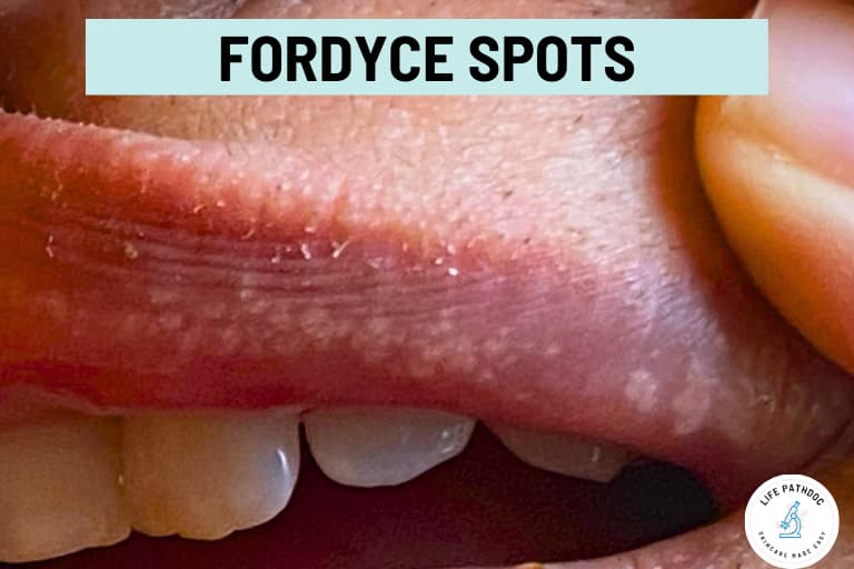 Fordyce Spots Identification Causes Treatment