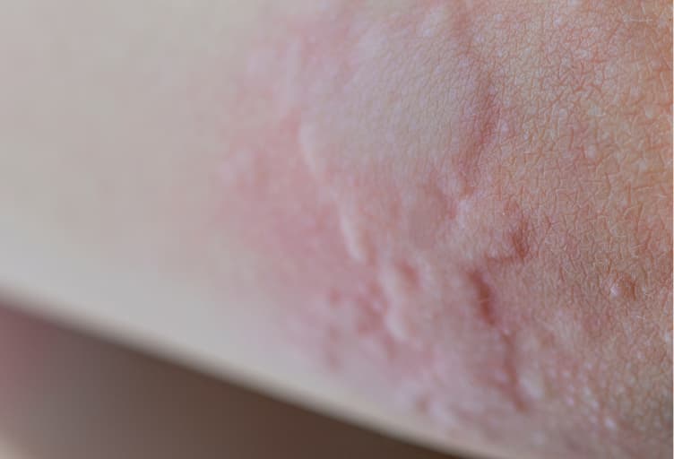 Hives Urticaria Pictures Types Causes Treatment Hives Urticaria Pictures Types Causes Treatment