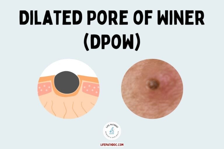 Dilated Pore of Winer (DPOW): Large Blackhead-Like Lesion
